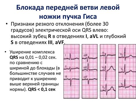 Неполная блокада правой ножки ГИСА