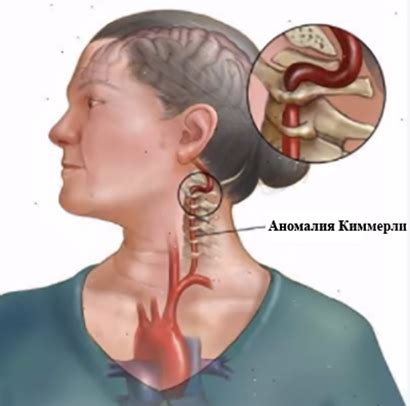 Неполная двусторонняя аномалия Киммерли