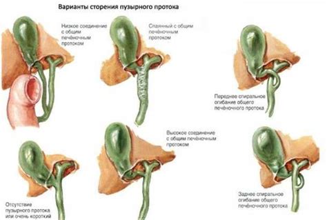 Неполная перегородка желчного пузыря: симптомы, причины, диагностика, лечение