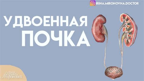 Неполное удвоение почки