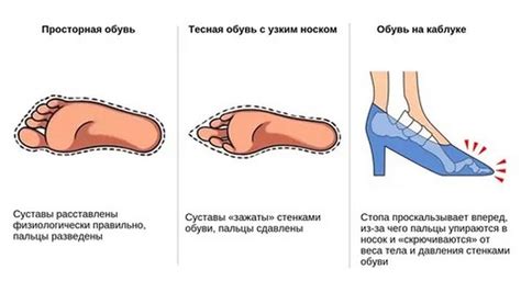 Неправильная обувь и ее влияние