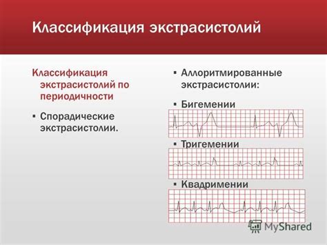 Неправильная правильность регистрации экстрасистолии