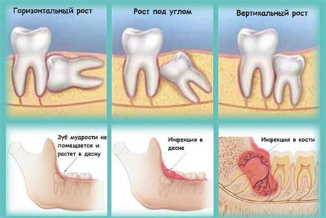 Неправильное положение зубов мудрости