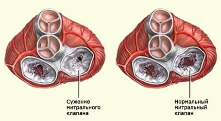 Неправильное функционирование сердечного клапана