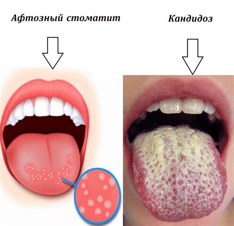 Неприятные симптомы волдырей на языке