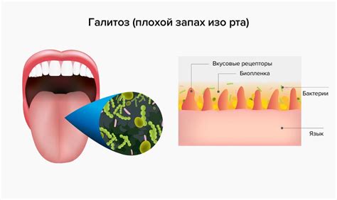 Неприятный запах изо рта