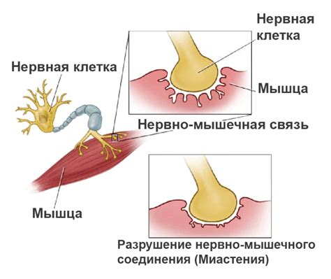 Нервно-мышечные заболевания