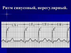 Нерегулярный синусовый ритм: основные причины