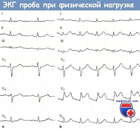 Неспецифическая депрессия ST-сегмента сердца: вызывающие факторы и симптомы