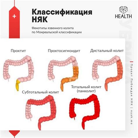 Неспецифический язвенный колит: основные аспекты