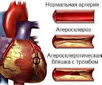 Нестабильная стенокардия: дефиниция и симптомы