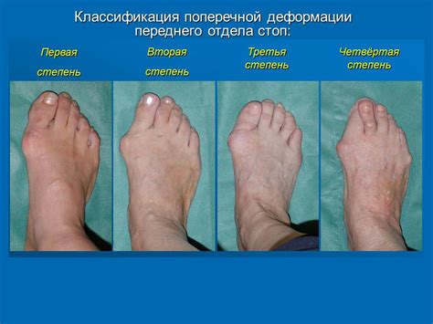 Нефиксированная деформация стопы