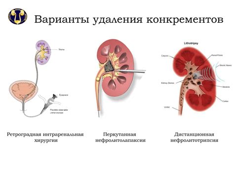 Нефролитиаз левой почки: причины, симптомы, диагностика и лечение