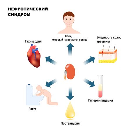 Нефротический синдром: основная информация и симптомы