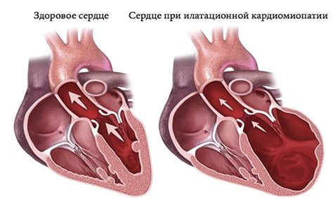 Низкий вольтаж в грудных отведениях