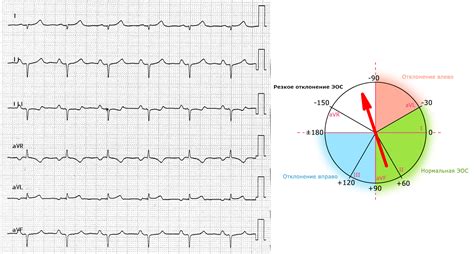 Нормальное положение электрической оси сердца
