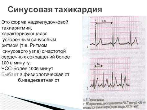 Нормосистолия с нерегулярным синусовым ритмом: что это?