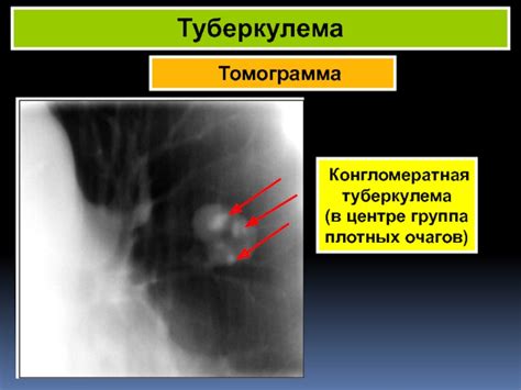 Обзор плотных очагов заболевания