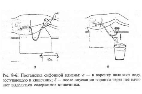 Обзор растворов для сифонной клизмы