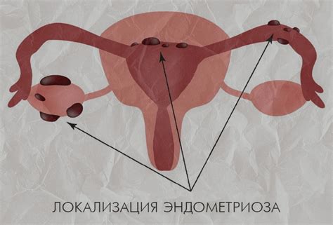 Обильные месячные со сгустками