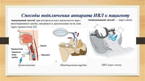 Области применения ИВЛ