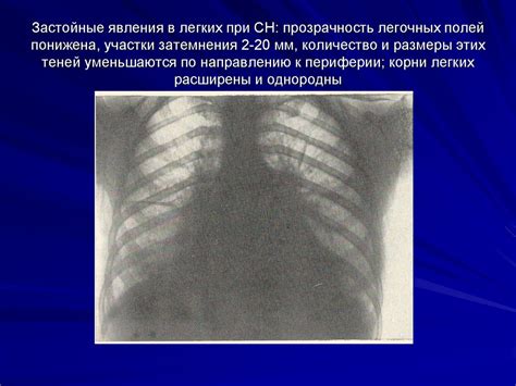 Обогащение легочных полей и его значение для здоровья