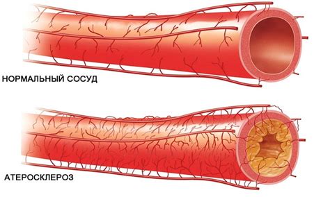 Образование атеросклеротических бляшек