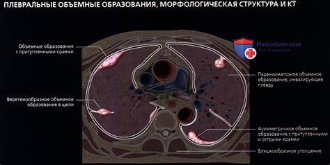 Образование плевры справа