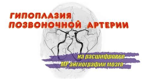 Обследование для выявления гипоплазии правой позвоночной артерии