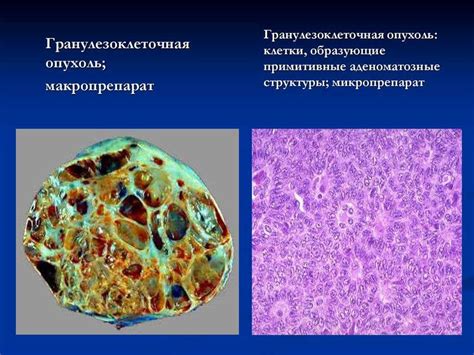 Обследование наличия гранулезоклеточной опухоли