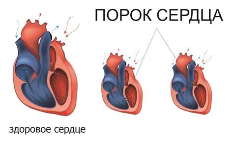 Обструктивный порок сердца