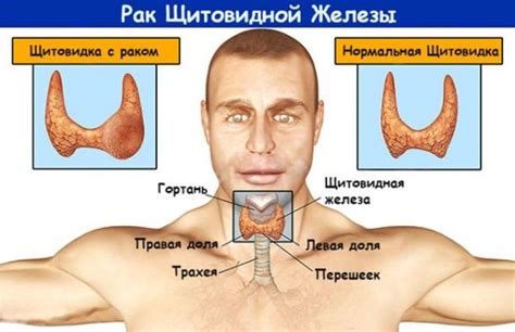 Объемное образование щитовидной железы: причины, симптомы, лечение