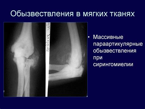 Обызвествление мягких тканей: определение и причины