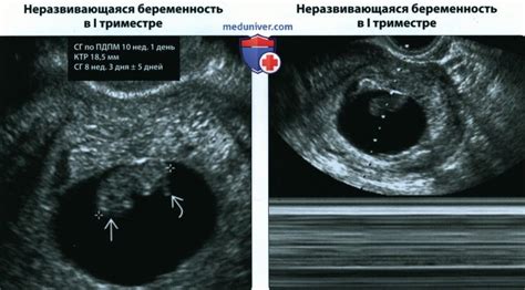 Одно деформированное плодное яйцо