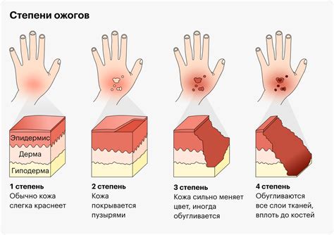 Ожоги: типы и степени тяжести