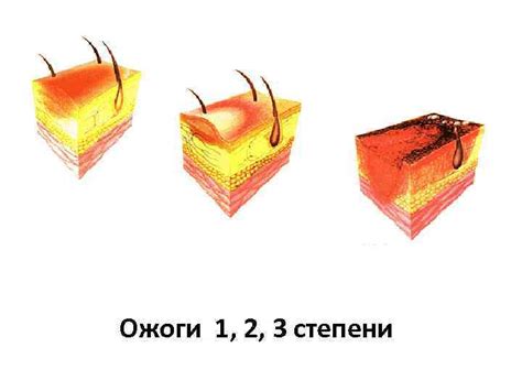 Ожоги третьей степени: причины и симптомы