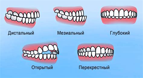 Опасности неправильного прикуса у ребенка