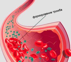 Опасность густой крови