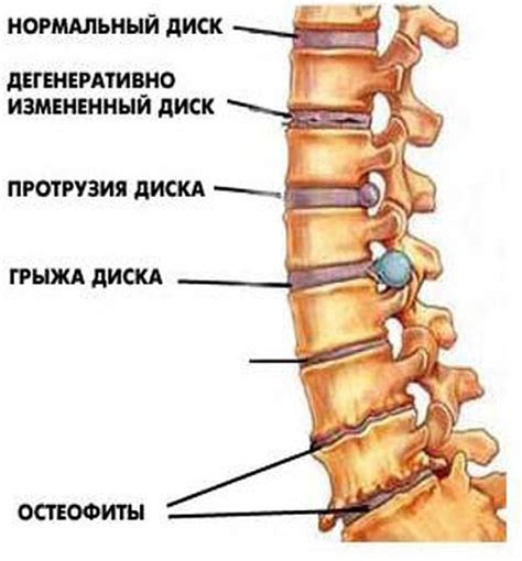 Опасные движения для грыжи позвонков 5-6 шейного отдела позвоночника