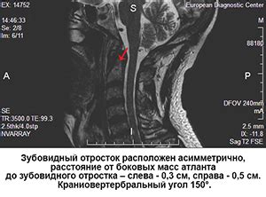 Описание краниовертебрального перехода