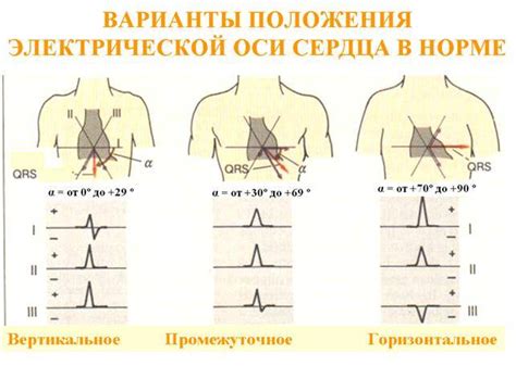 Описание отклонения оси сердца