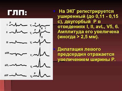 Определение ГЛП на ЭКГ