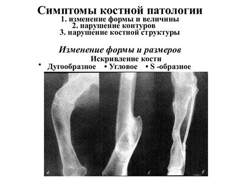 Определение выраженной костной структуры