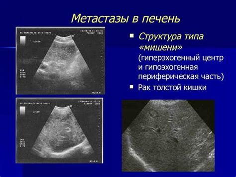 Определение гиперэхогенного включения