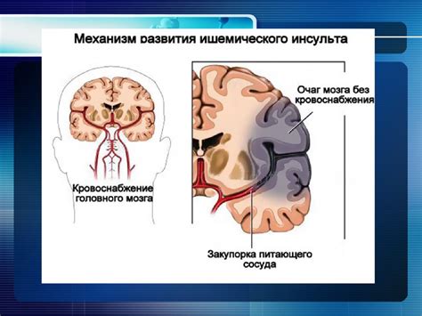 Определение ишемического инсульта