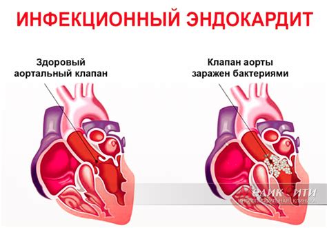 Определение и классификация эндокардита