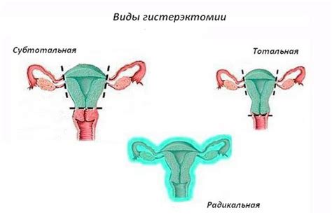 Определение и суть процедуры гистерэктомии матки