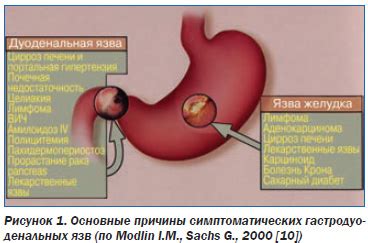 Определение и сущность гастропатии папулезной