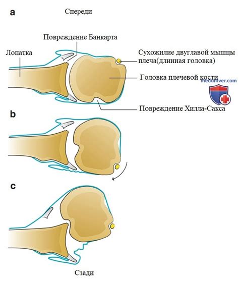 Определение и сущность подвывиха по ковчегу