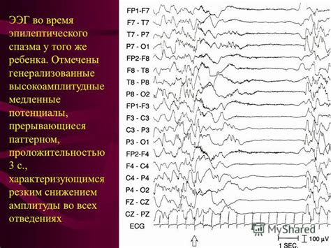 Определение невротического паттерна ЭЭГ